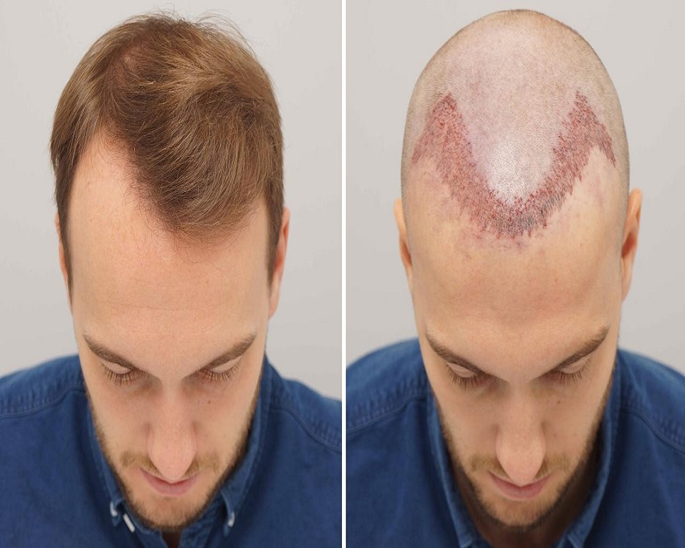 زراعة الشعر في العراق - تخلص من مشكلة الصلع فورا 5381 1