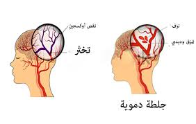 تعرف على اسباب الجلطة الدماغية - اسباب جلطة المخ 3989 2