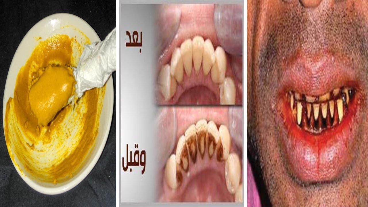 الكركم لتبييض الاسنان - كيف تجعلى سنانك مثل اللولى 1719 6