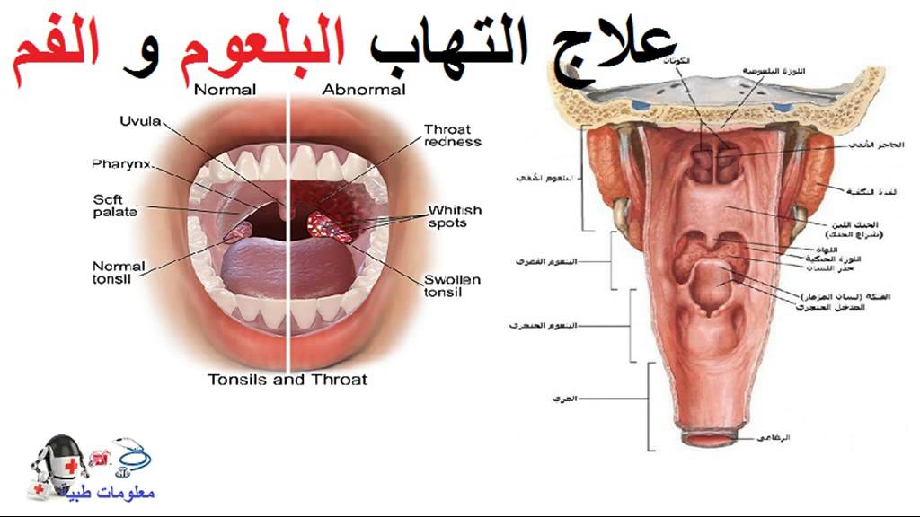 الم في الجهه اليسرى من الحلق - اسباب التهاب البلعوم لكن من جهة واحدة 4002 2