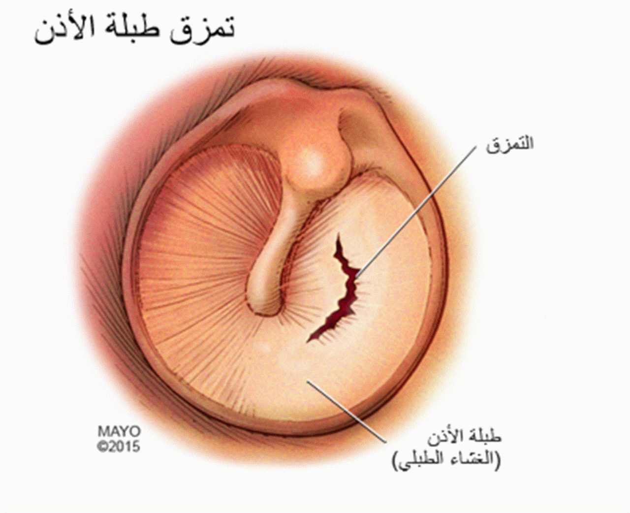 اسباب صفير الاذن - نعم الله الكثيره 1686