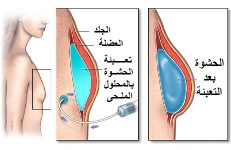 عملية تكبير الثدي - تعرفي على عملية تهم كل من يلجا الى عمليات التجميل 700 2