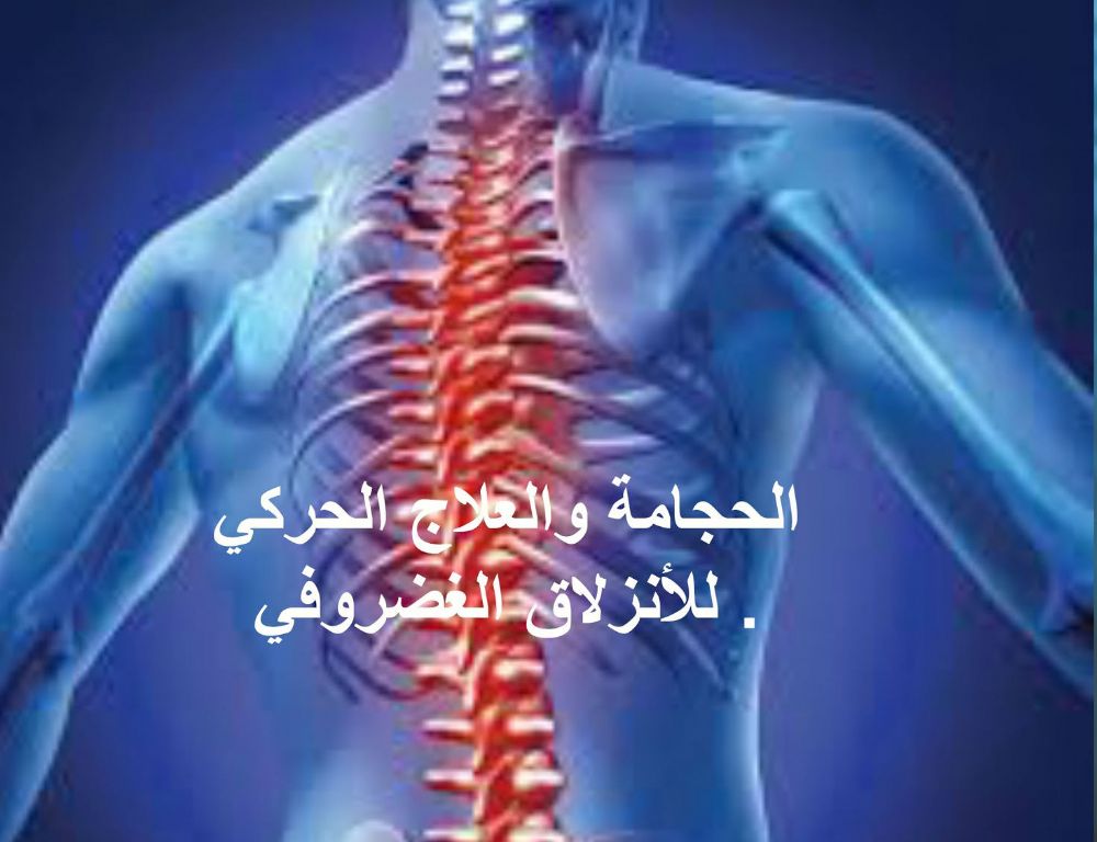 علاج الانزلاق الغضروفي بالحجامة - اسباب وعلاج انزلاق غضروف الظهر 187