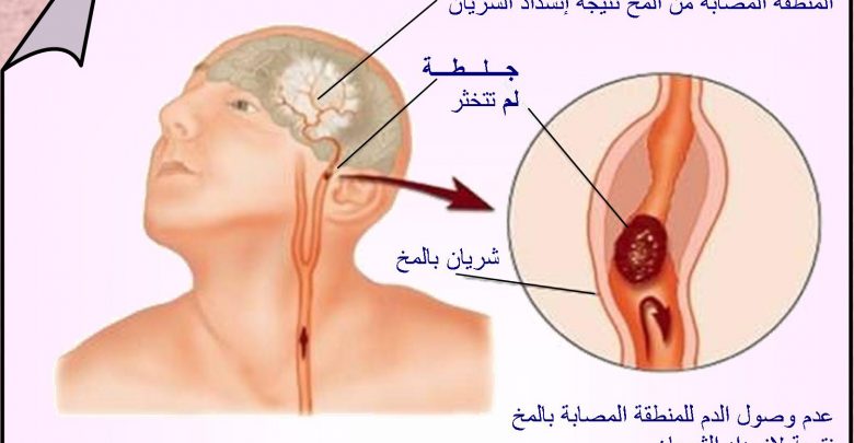 تعرف على اسباب الجلطة الدماغية - اسباب جلطة المخ 3989 1