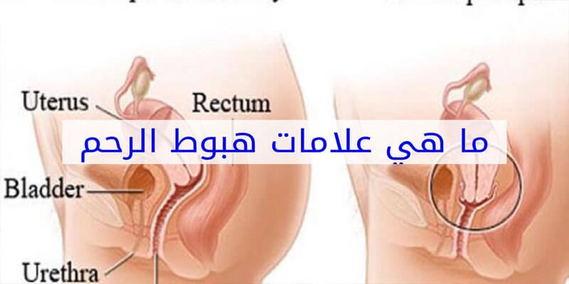 اعراض هبوط الرحم - مشاكل كثيرة تتعرض لها المراة يجب الحذر منها 3258