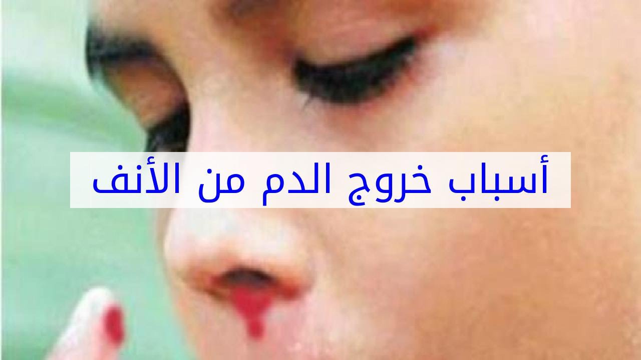 سبب نزول الدم من الانف - نزيف الانف واخطر اسبابه 5459 2