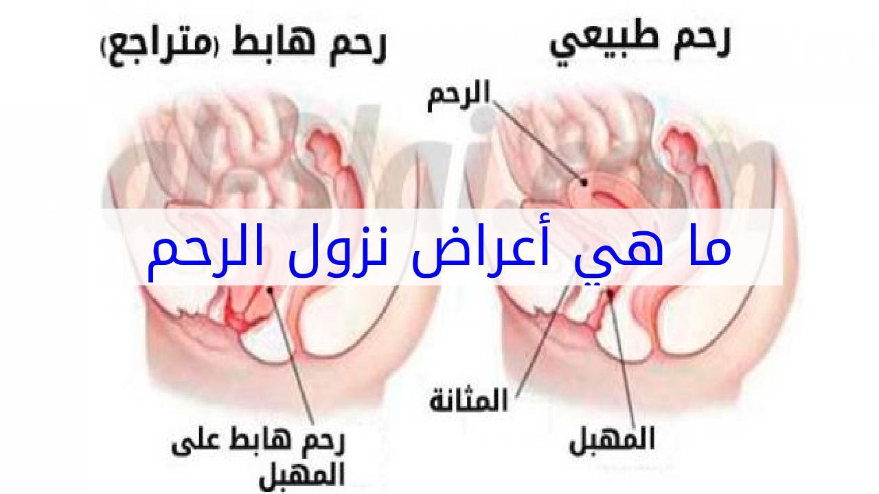 صور هبوط المهبل- اعراض هبوط المهبل بالصور 3089 4