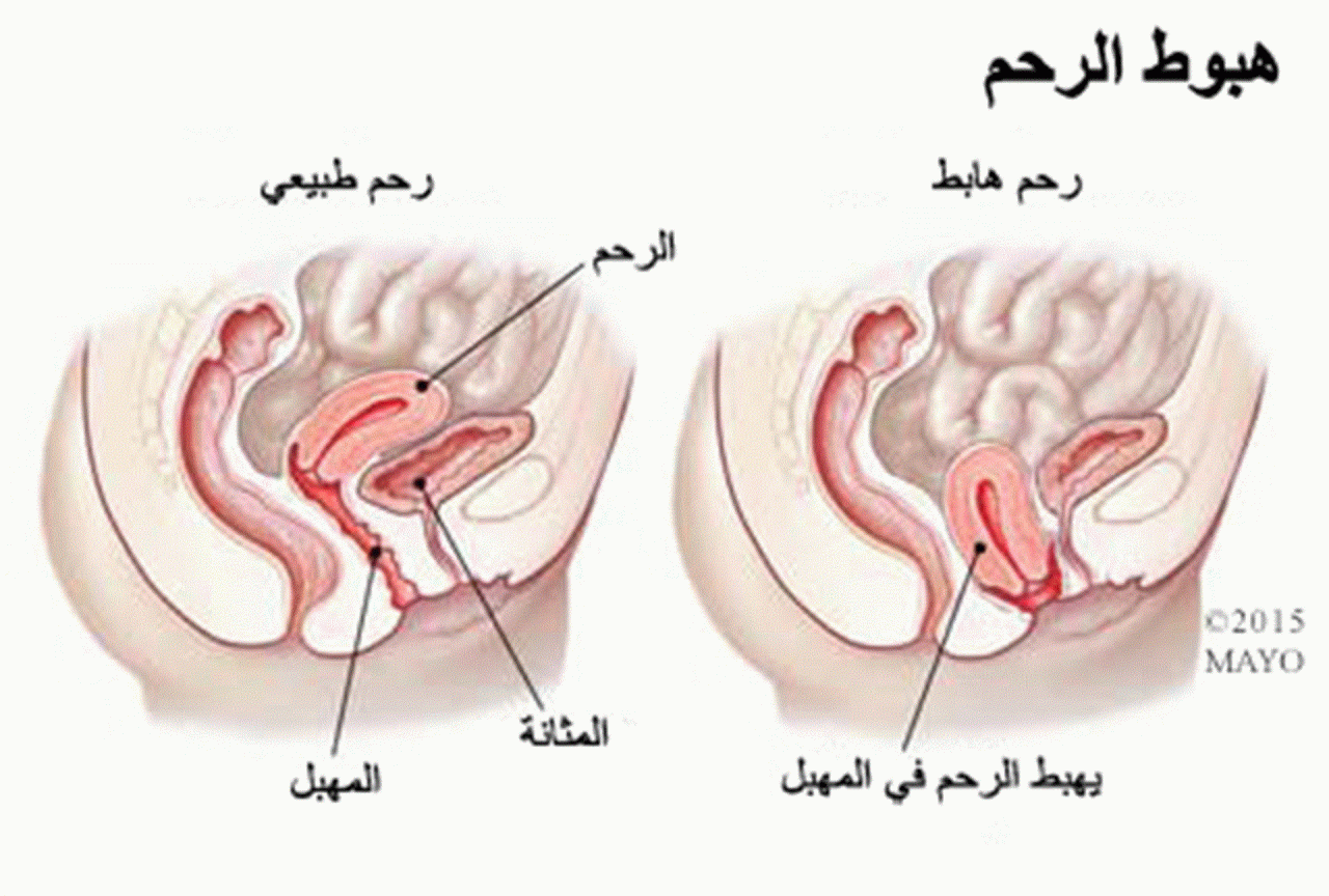 صور هبوط المهبل- اعراض هبوط المهبل بالصور 3089