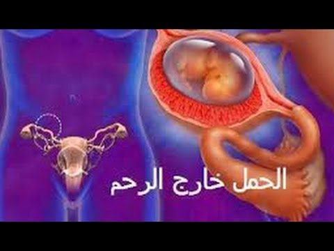 اعراض الحمل خارج الرحم - مشاكل الحمل كثيرة منها الحمل في غير موضعه 3452 2