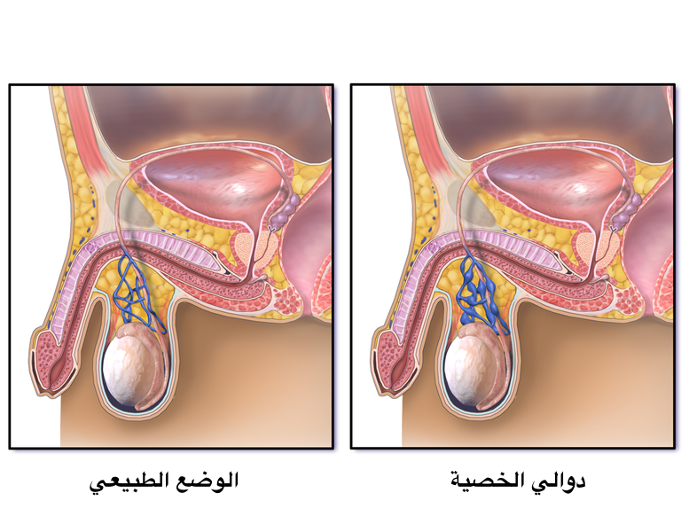 علامات فشل عملية دوالي الخصية - تعرف على مضاعفات عمليه دوالي الخصيه 2339