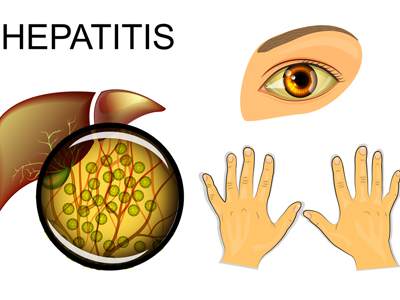 اعراض التهاب الكبد , مشاكل الكبد منها التهاب المزمن للكبد
