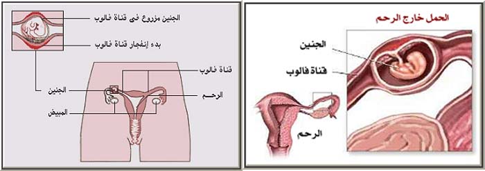 كيف اعرف الحمل خارج الرحم - في الشهر الثاني والدكتور قالي حمل خارج الرحم 912 2