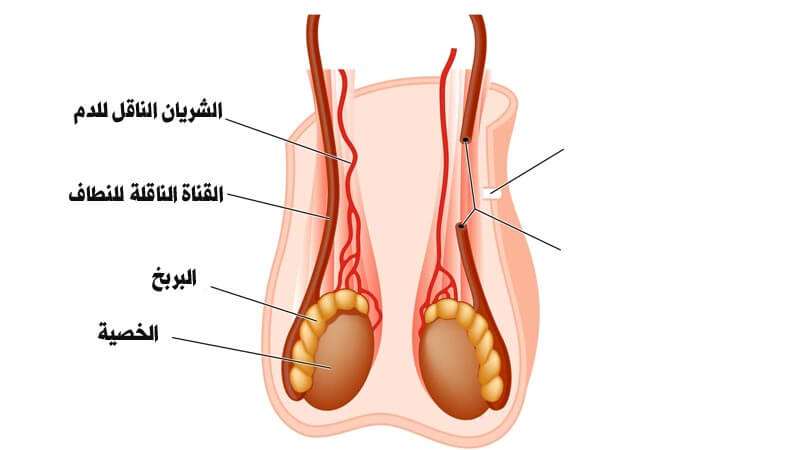 علامات فشل عملية دوالي الخصية - تعرف على مضاعفات عمليه دوالي الخصيه 2339 1