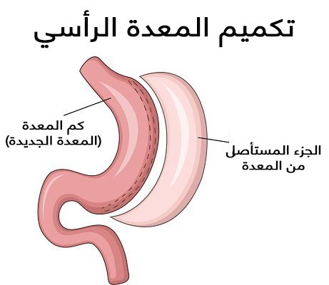 عملية تكميم المعدة في مصر - شفط المعدة وتصغيرها 1083