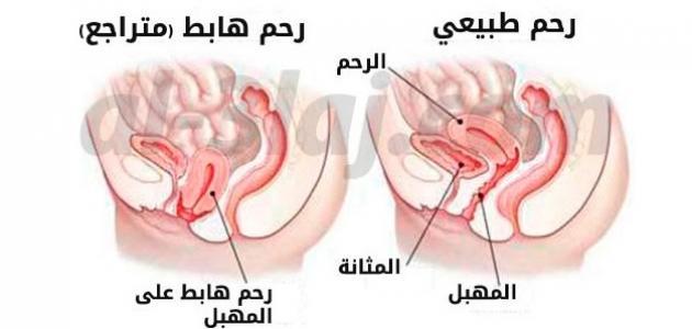 اعراض هبوط الرحم - مشاكل كثيرة تتعرض لها المراة يجب الحذر منها 3258 1