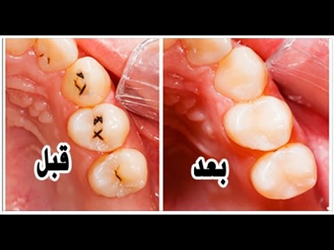 تخلص من تسوس الاسنان , احصلي علي اسنان هوليود