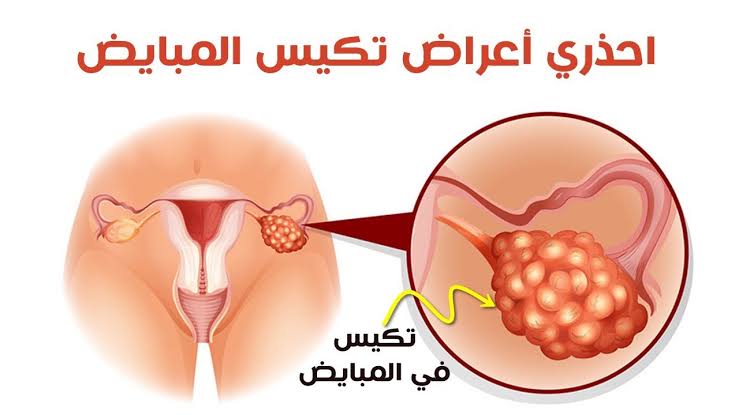 تكيس المبايض واعراضه - مخاطر و اعراض تكيس المبيض 964 2