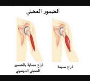 علاج ضمور العضلات في امريكا , تعرف على الدواء الاغلى في التاريخ