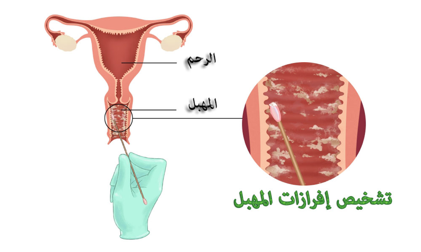 اسباب افرازات المهبل - متى تقلقي من الافرازات المهبلية 5563