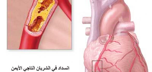 ماهي اعراض مرض القلب - احذر من هذه الاعراض 1971 2