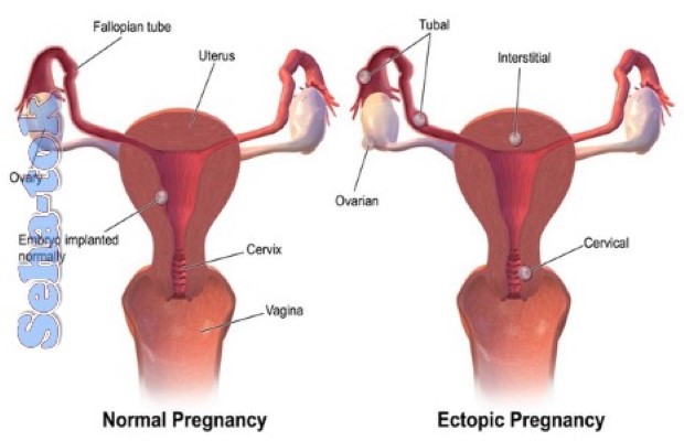 اعراض الحمل خارج الرحم , مشاكل الحمل كثيرة منها الحمل في غير موضعه