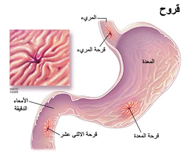 اسباب جرثومة المعدة - جرثومة المعدة ومشاكلها واسهل الحلول 334 2