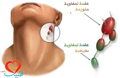 الم في الجهه اليسرى من الحلق - اسباب التهاب البلعوم لكن من جهة واحدة 4002