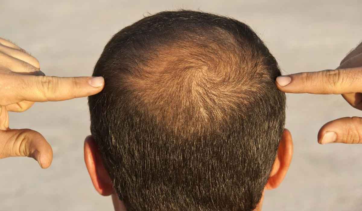 كم يستغرق نمو شعر الرأس المقصودة لدى الأطفال