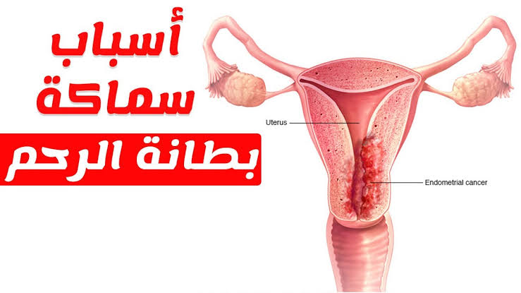 ماهو علاج سماكة بطانة الرحم , اعرفى كل شى عن بطانه الرحم وطرق العلاج