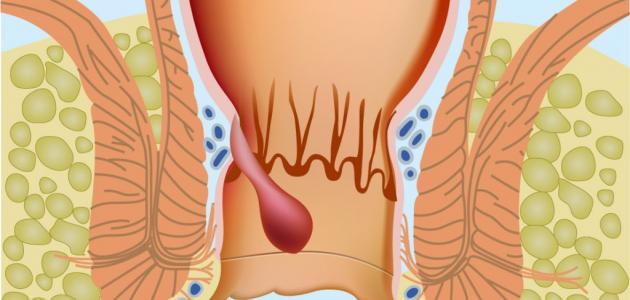 اعراض مرض البواسير - مرض مؤلم في بعض الاحيان ومخجل العلاج ايضا 745 3